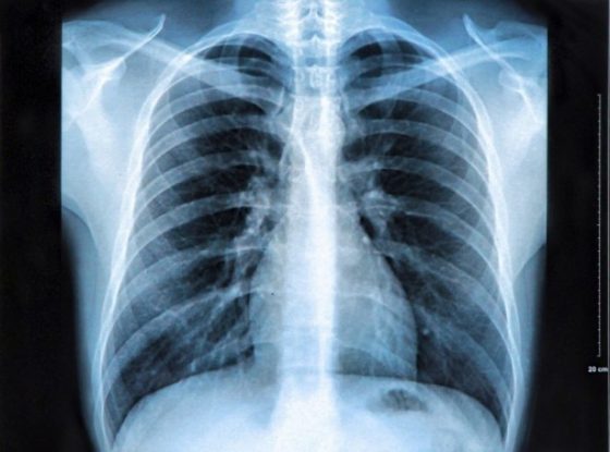 Washington Post destaca acuerdo sobre vacuna cubana contra el cáncer del pulmón