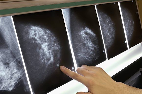 Una mamografía. Foto: Getty Images